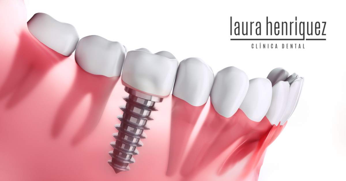 Modelo dental ilustrado con encía traslúcida que muestra un implante dental colocado en el hueso de la mandíbula - Clínica Dental Henríquez