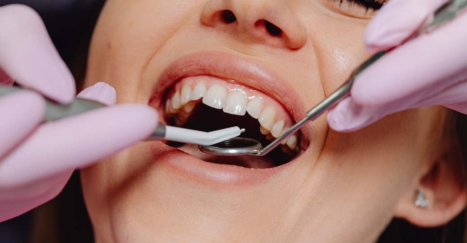 recesion-gingival-tratamiento.webp